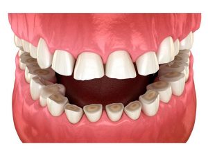 Aumentan los casos de bruxismo