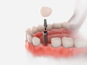 Innovación en implantes dentales